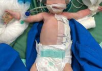 انجام موفقیت‌آمیز عمل جراحی کیست مادرزادی جدار شکم بر روی نوزاد ۱۱ روزه