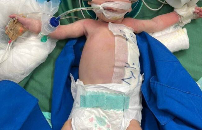 انجام موفقیت‌آمیز عمل جراحی کیست مادرزادی جدار شکم بر روی نوزاد ۱۱ روزه