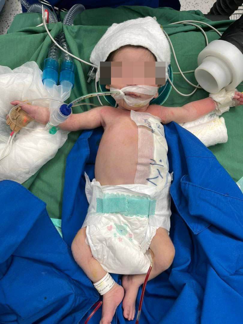 انجام موفقیتآمیز عمل جراحی کیست مادرزادی جدار شکم بر روی نوزاد ۱۱ روزه